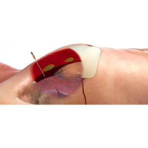 Needle, Decompression ARS,