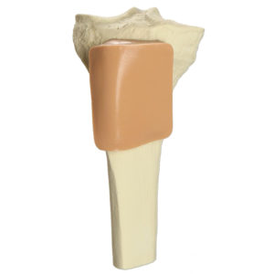 IO Bone, Tibia with Skin Patch, Proximal