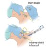 Cricothyroidotomy Pack, Bougie Aided BAC-Pack,