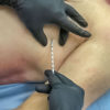 Needle, Decompression SPEAR - Simplified Pneumothorax Emergency Air Release,