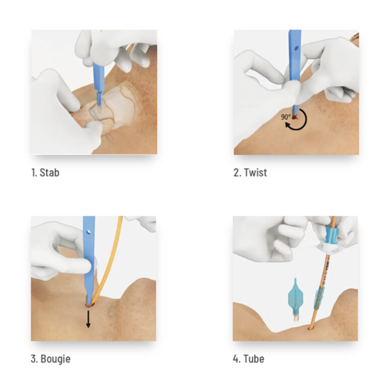 Cric Kit, ScalpelCric, Disposable, - Penn Care, Inc.